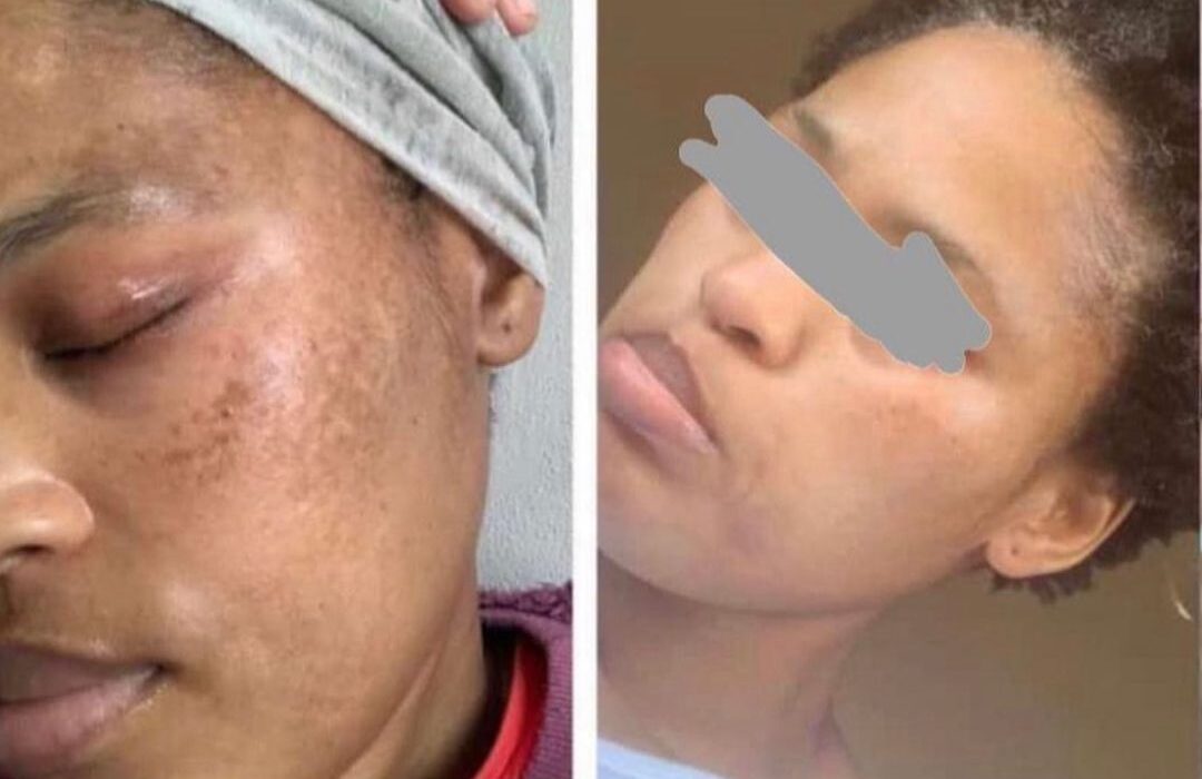 before and after treating melasma