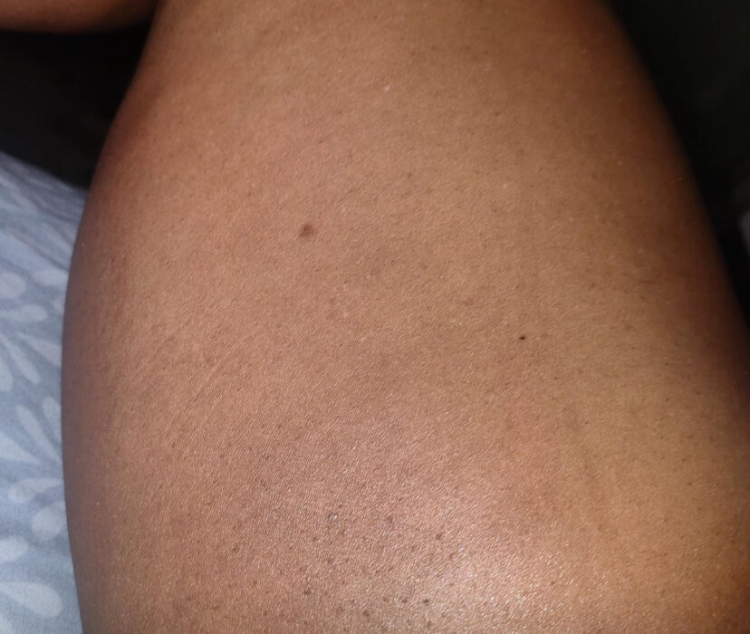 picture showing a lady that has leared her dark inner thighs