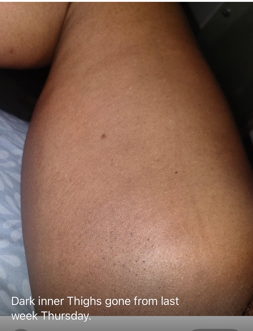 picture showing a lady that has leared her dark inner thighs